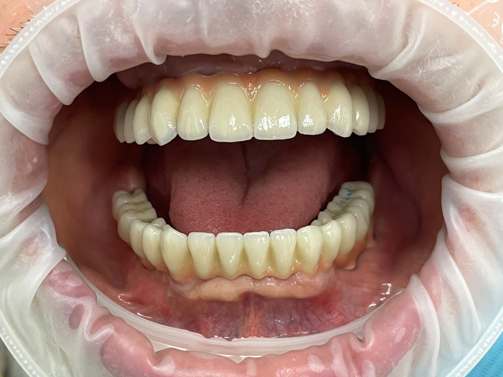 Имплантация зубов All-on-6